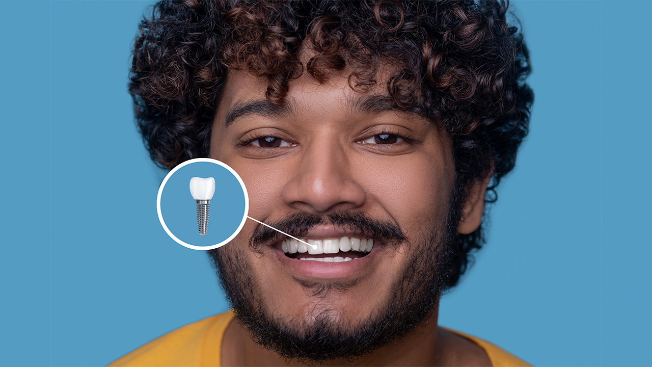 A person smiling and a cutaway of a dental implant superimposed