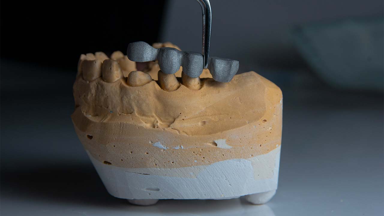 This photo shows a dental structure with implants in the process of being manufactured inside a laboratory.