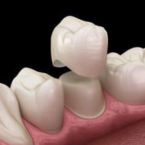 Aumento de corona clínica en periodoncia para mejorar estética y funcionalidad dental.