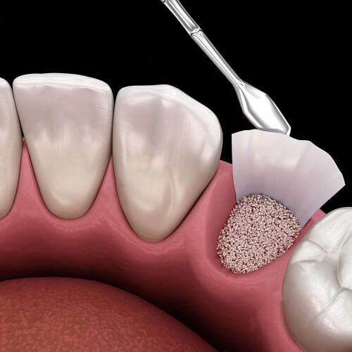 Ilustración de procedimiento periodontal: exodoncia atraumática con regeneración ósea en encía.