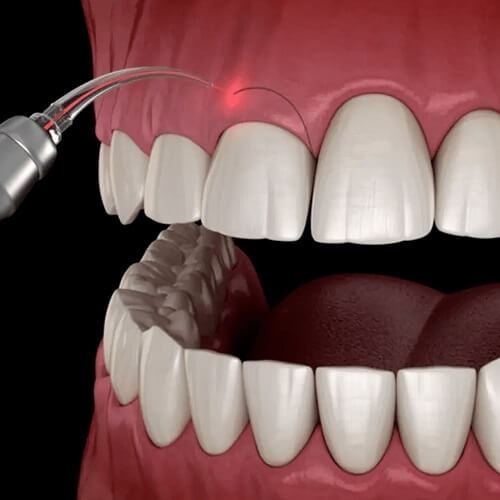 Procedimiento periodontal de nivelación de puntos zenith en encías con láser.