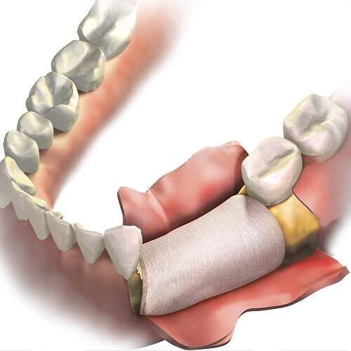 Procedimiento de regeneración ósea guiada en periodoncia para recuperar soporte dental.