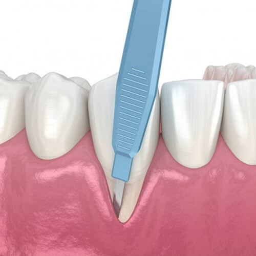 Procedimiento periodontal de regeneración tisular guiada para tratar pérdida de encía y hueso.