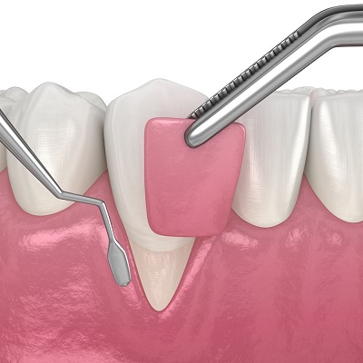 Procedimiento de cirugía plástica periodontal para corregir recesión de encías y mejorar estética dental.