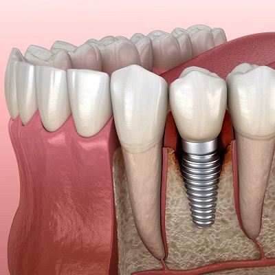 Implante dental colocado en hueso maxilar para reemplazar un diente perdido.