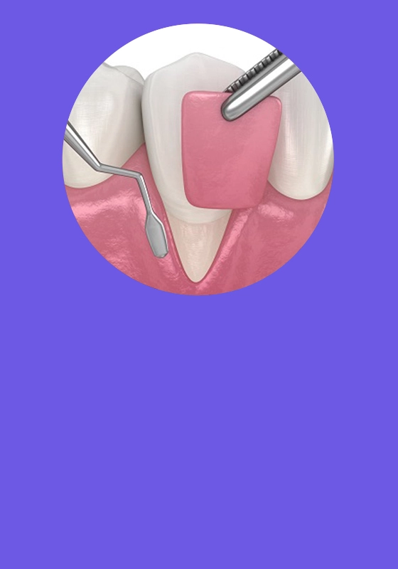Procedimiento de cirugía plástica periodontal en encía - Dra. Juliana Echeverri periodoncista Armenia Quindío