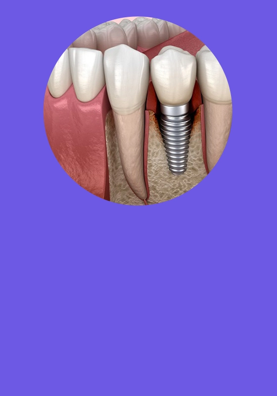 Implante dental colocado en hueso para reemplazar pieza perdida - Dra. Juliana Echeverri periodoncista en Armenia Quindío